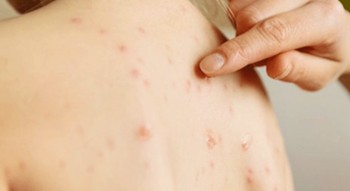 मलंगवा नगरपालिकामा फैलियो दादुरा संक्रमण