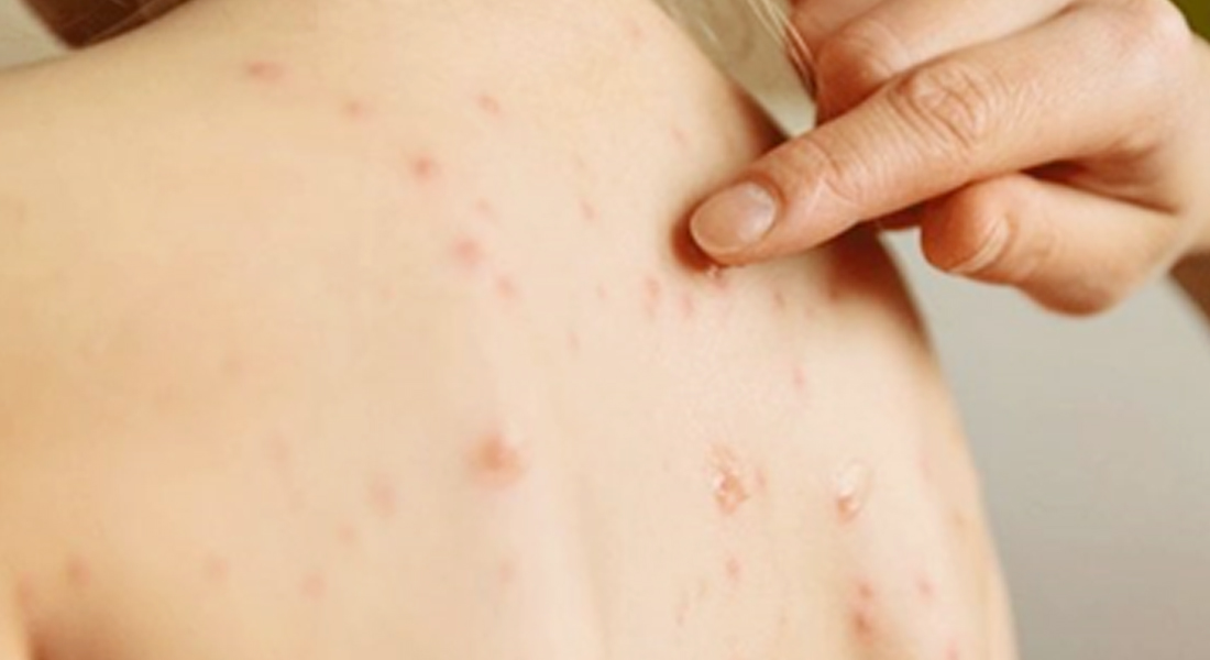 मलंगवा नगरपालिकामा फैलियो दादुरा संक्रमण